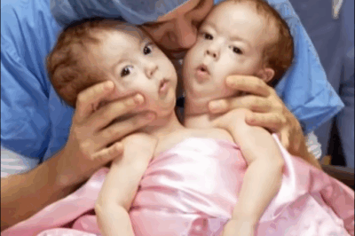Born Conjoined, Bella and Abby’s Lives Transformed After a Life-Changing Surgery